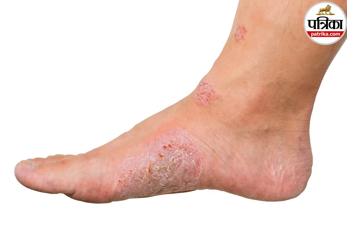 Wound on leg not healing after 2 weeks,NHS leg ulcer guidelines,Venous leg ulcer treatment,Why is my leg wound not healing,