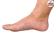 Wound on leg not healing after 2 weeks,NHS leg ulcer guidelines,Venous leg ulcer treatment,Why is my leg wound not healing,