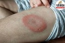 Lyme disease symptoms and prevention NHS,Bullseye rash tick bite symptoms,Early warning signs of Lyme disease,,