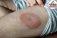 Lyme disease symptoms and prevention NHS,Bullseye rash tick bite symptoms,Early warning signs of Lyme disease,,