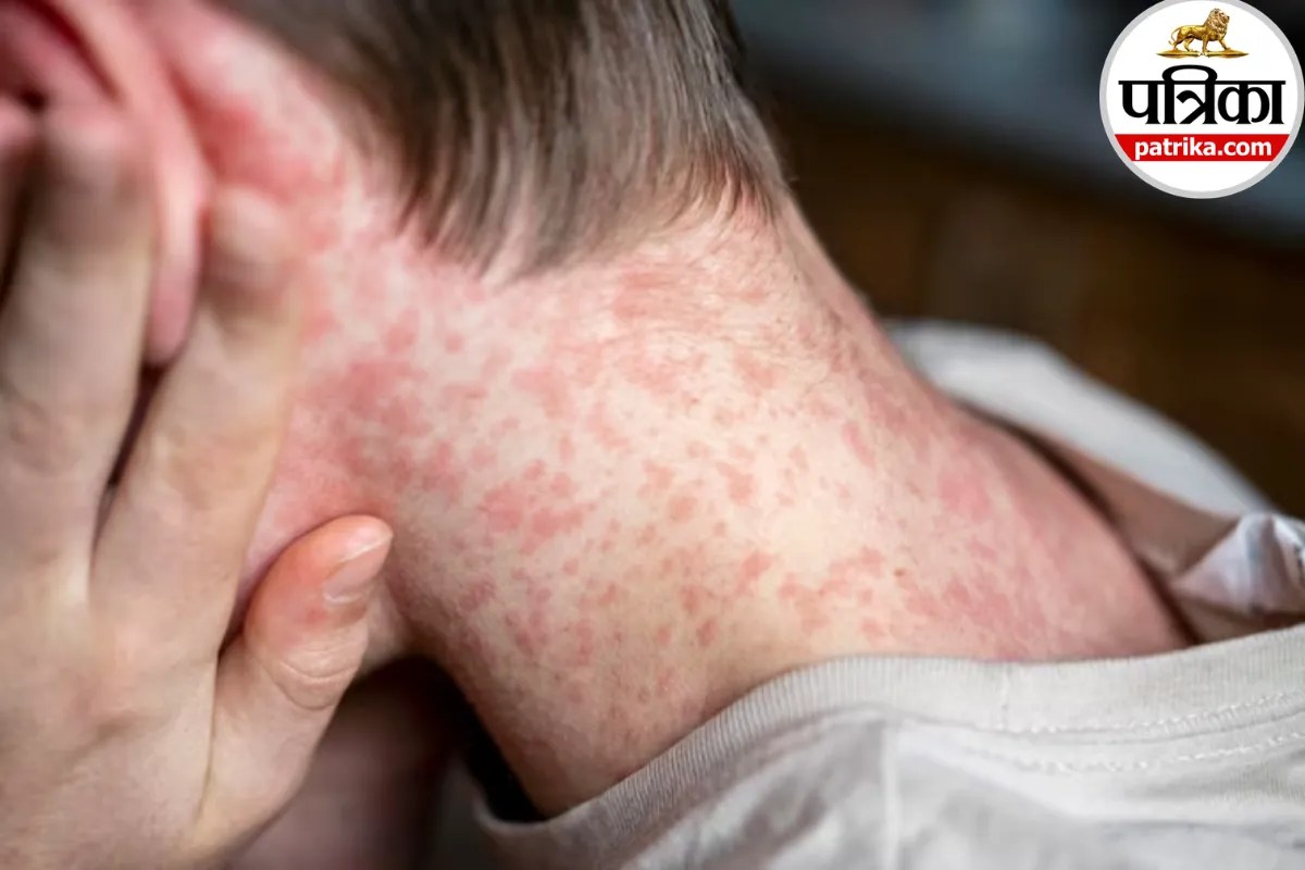 Measles symptoms in Hindi ,What is Measles disease,Measles rash early signs,