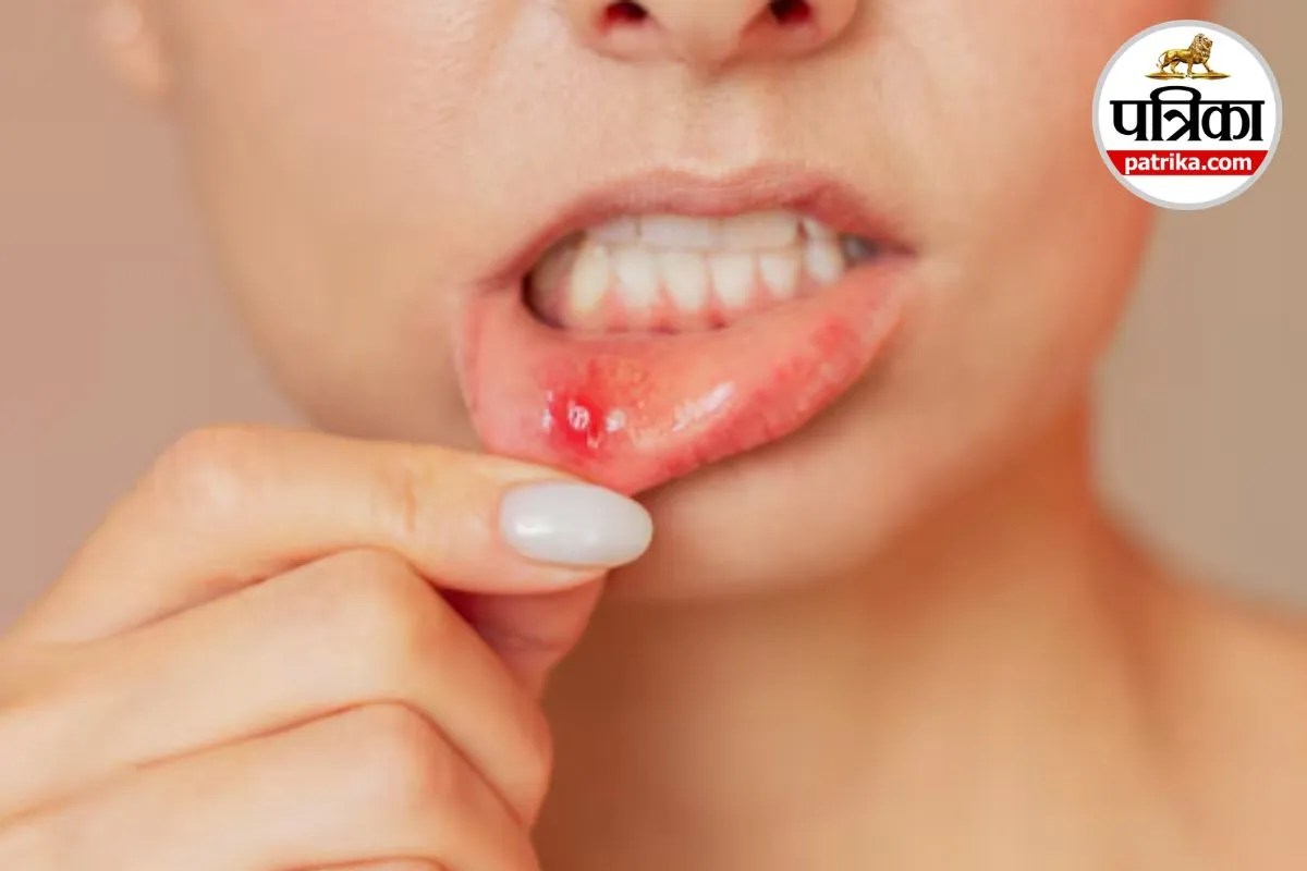 Mouth Ulcers Recurrent Aphthous Stomatitis Canker Sores