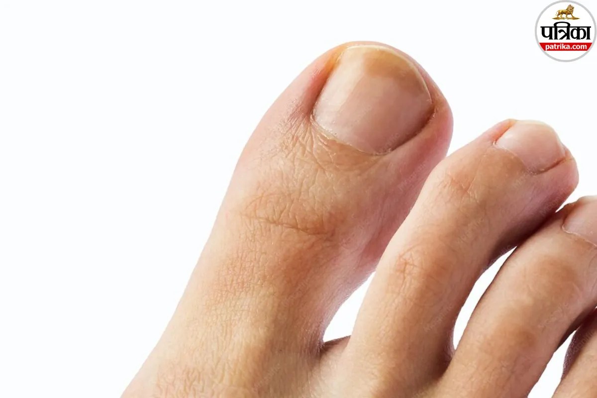 nail fungus symptoms mayo clinic,yellow thick nails causes ,signs of toenail fungus ,