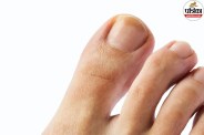 nail fungus symptoms mayo clinic,yellow thick nails causes ,signs of toenail fungus ,