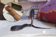 snake bite in mp: महिला के पैर पर सांप ने काटा (Photo Source - Patrika)