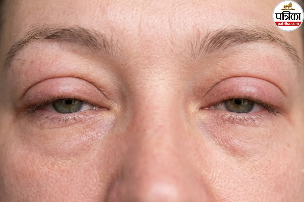 Orbital cellulitis symptoms and treatment ,Eye infection orbital cellulitis,Causes of orbital cellulitis