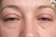 Orbital cellulitis symptoms and treatment ,Eye infection orbital cellulitis,Causes of orbital cellulitis