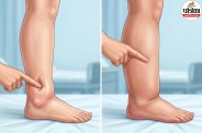 Body swelling types,Pitting edema vs Non pitting edema,Symptoms of edema,