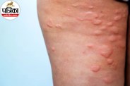 SLE disease symptoms ,What is Lupus disease,Autoimmune disease symptoms,