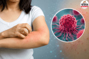 Cancer Itching Symptoms, Persistent Itchy Skin