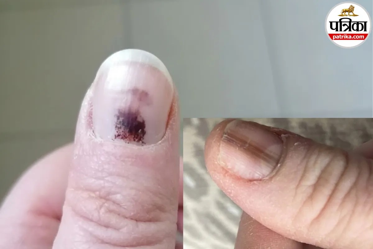 Black line on nail cancer symptoms,Subungual melanoma signs in Hindi,Dark streak under fingernail causes