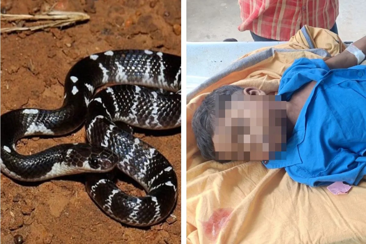 Snake bite