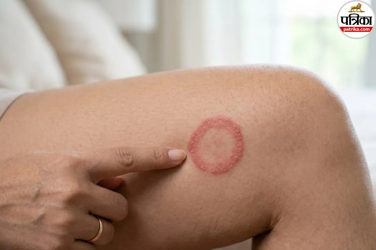 tinea infection symptoms in hindi ,ringworm treatment in rainy season,