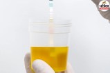 Urine Culture Test Purpose,UTI symptoms burning urination,Cleveland Clinic urine culture,
