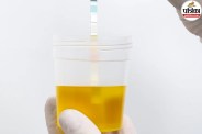 Urine Culture Test Purpose,UTI symptoms burning urination,Cleveland Clinic urine culture,