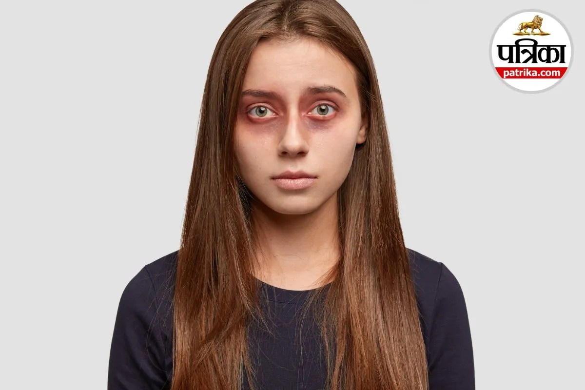 Dark Circles Symptoms Dark Circles Causes Hindi Eye Dark Circles