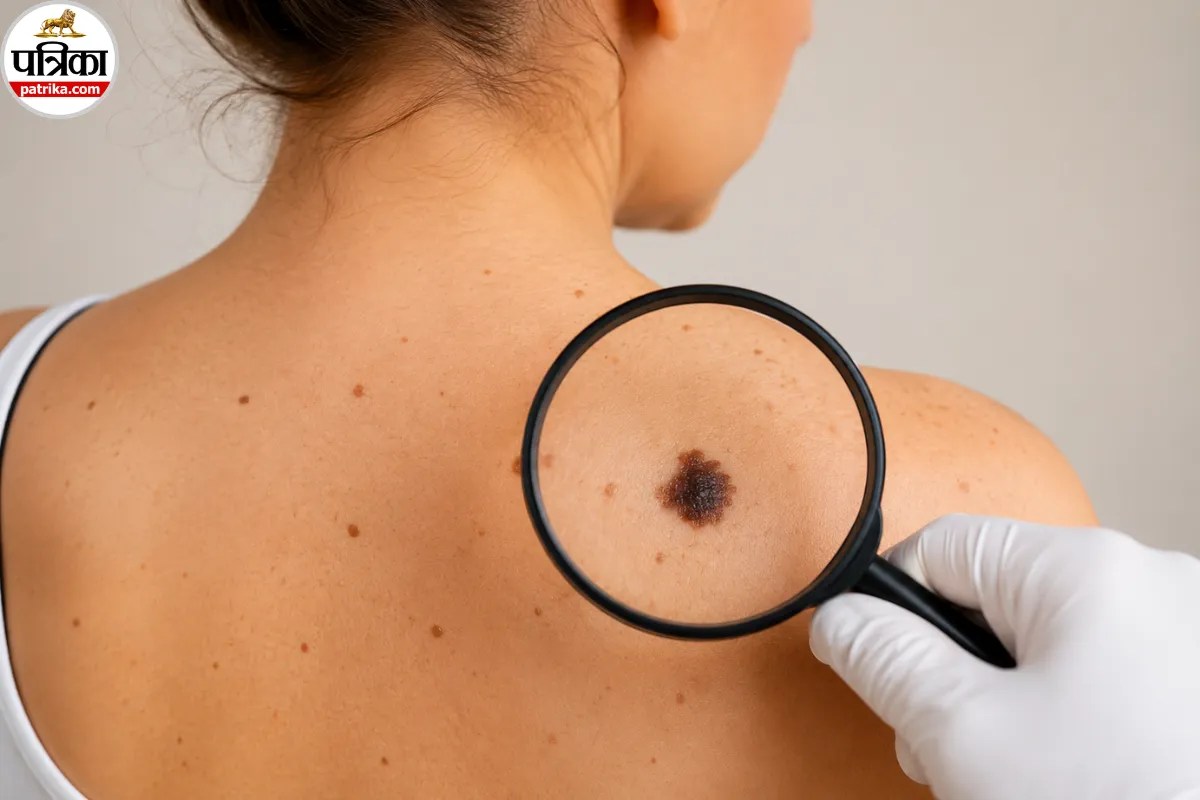 Skin Cancer Symptoms, Warning Signs Of Melanoma