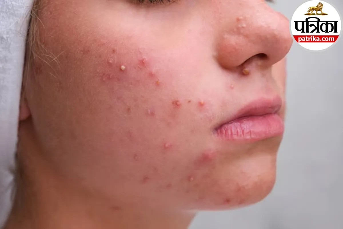 Acne Causes Mayo Clinic,Hormonal Acne Triggers,Pimples Prevention Tips,