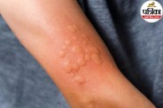 Actinic keratosis symptoms and causes,Rough scaly skin patch on face,Actinic keratosis pre-cancerous signs,