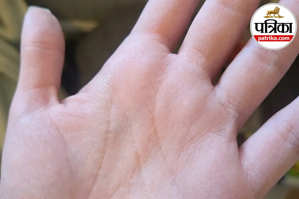 Aquagenic wrinkling of the palms causes,Rapid palm wrinkling in water,Cystic fibrosis palm wrinkling symptom,