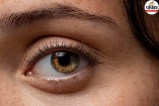 Macular hole symptoms,Straight lines look wavy eye,Vitrectomy surgery for macular hole,