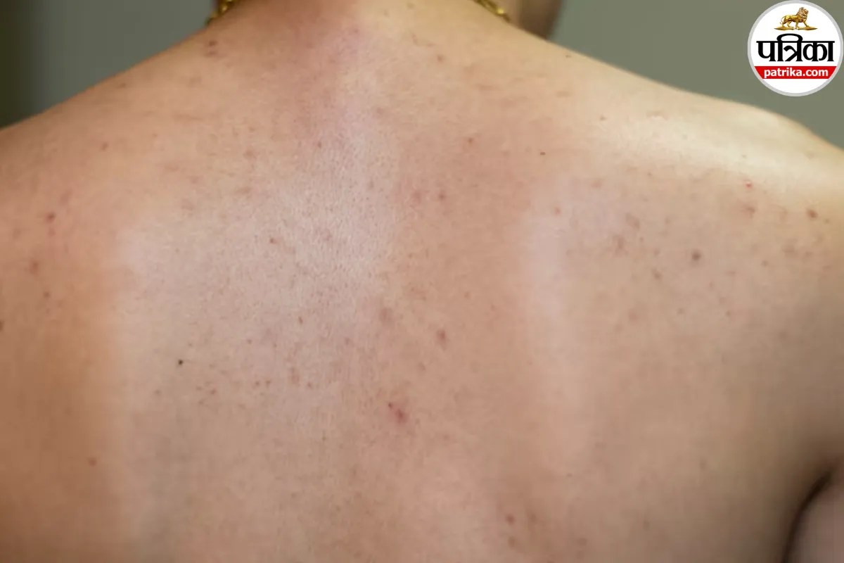 Back acne causes,How to get rid of bacne,Back acne treatment at home,