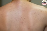 Back acne causes,How to get rid of bacne,Back acne treatment at home,
