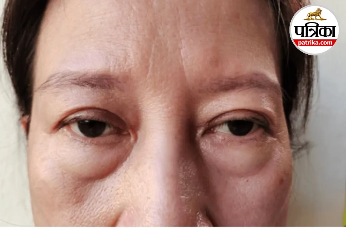 Eye bags causes,Under eye swelling remedies,Puffy eyes prevention,