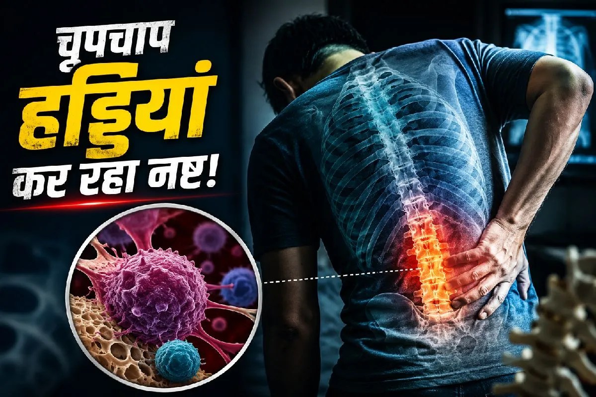 Bone fracture without injury due to cancer multiple myeloma