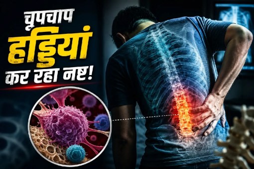 Bone fracture without injury due to cancer multiple myeloma