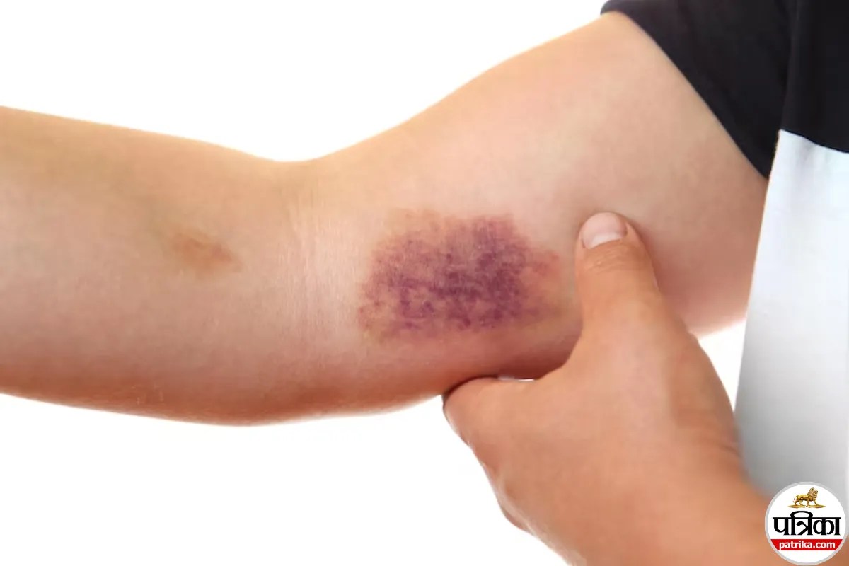 Easy Bruising Causes, Easy Bruising In Hindi
