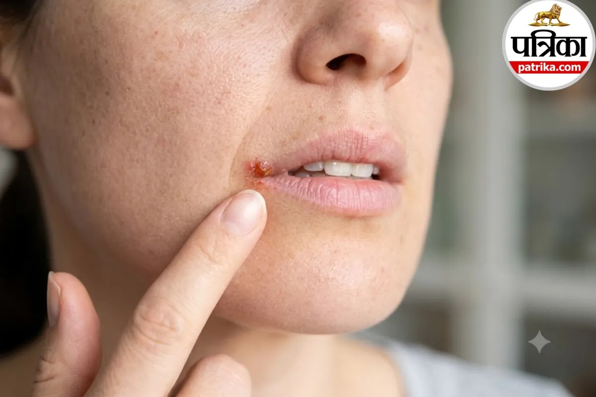 Cold Sores,Cold Sore Causes,Cold Sore Symptoms,
