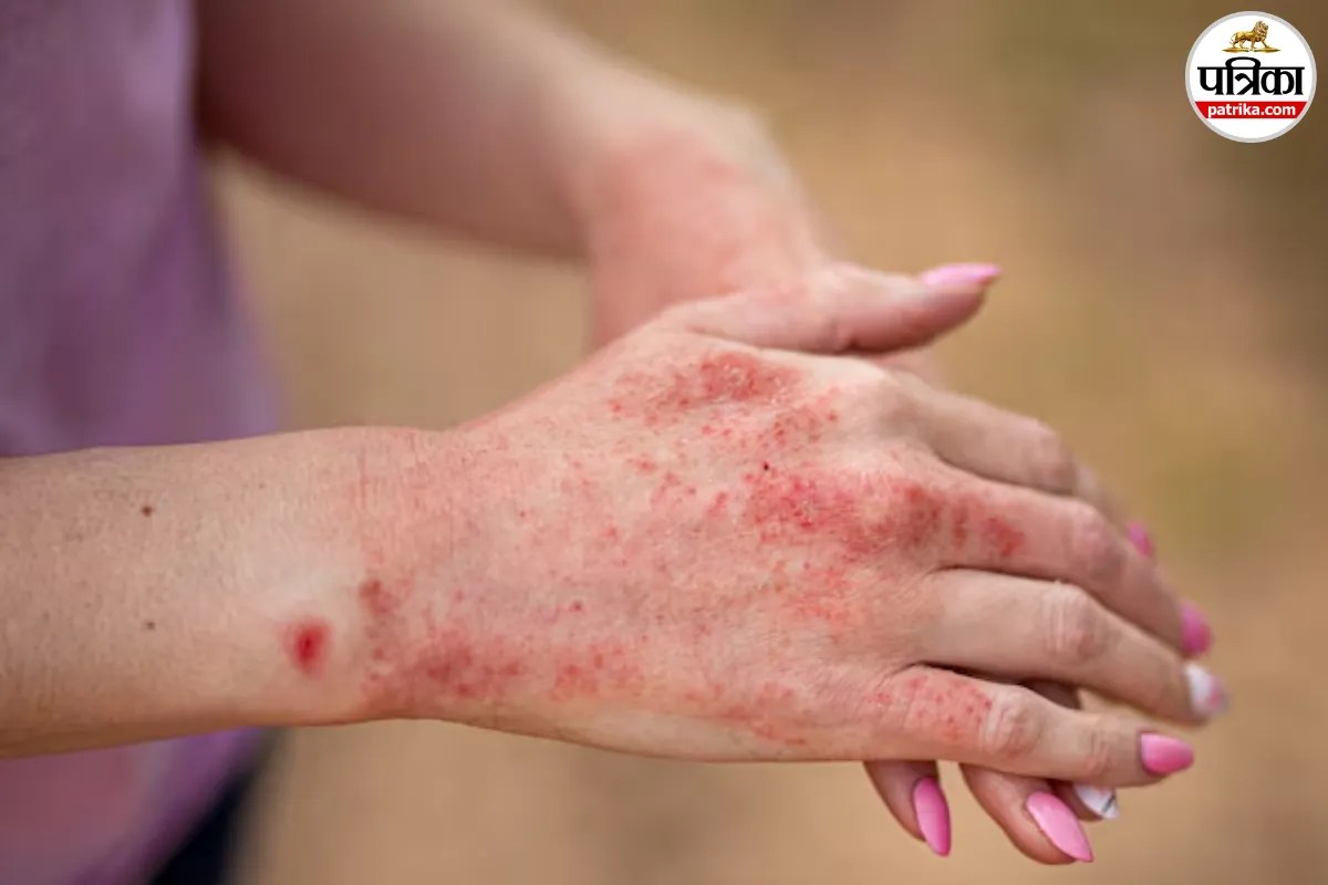 Contact Dermatitis Treatment, Contact Dermatitis Prevention