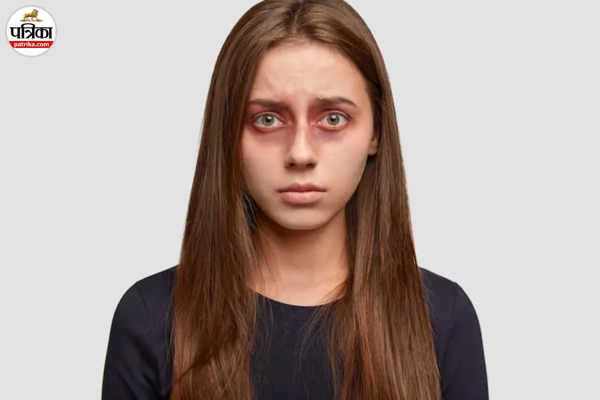 Aankhon Ke Neeche Kaale Ghere, Dark Circles Ke Gharelu Upay