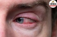 Keratitis Eye Infection Symptoms,Cornea Inflammation Causes,Eye Irritation and Watering,