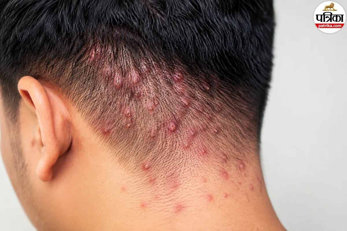 Scalp Folliculitis Symptoms, Scalp Folliculitis Causes