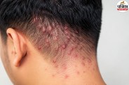 Scalp Folliculitis Symptoms, Scalp Folliculitis Causes