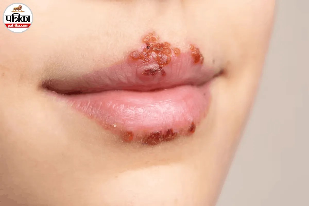 Oral Herpes, Cold Sore