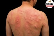 hives Causes and Symptoms in Hindi,Skin Allergy Hives Treatment,Chronic Hives ACAAI,