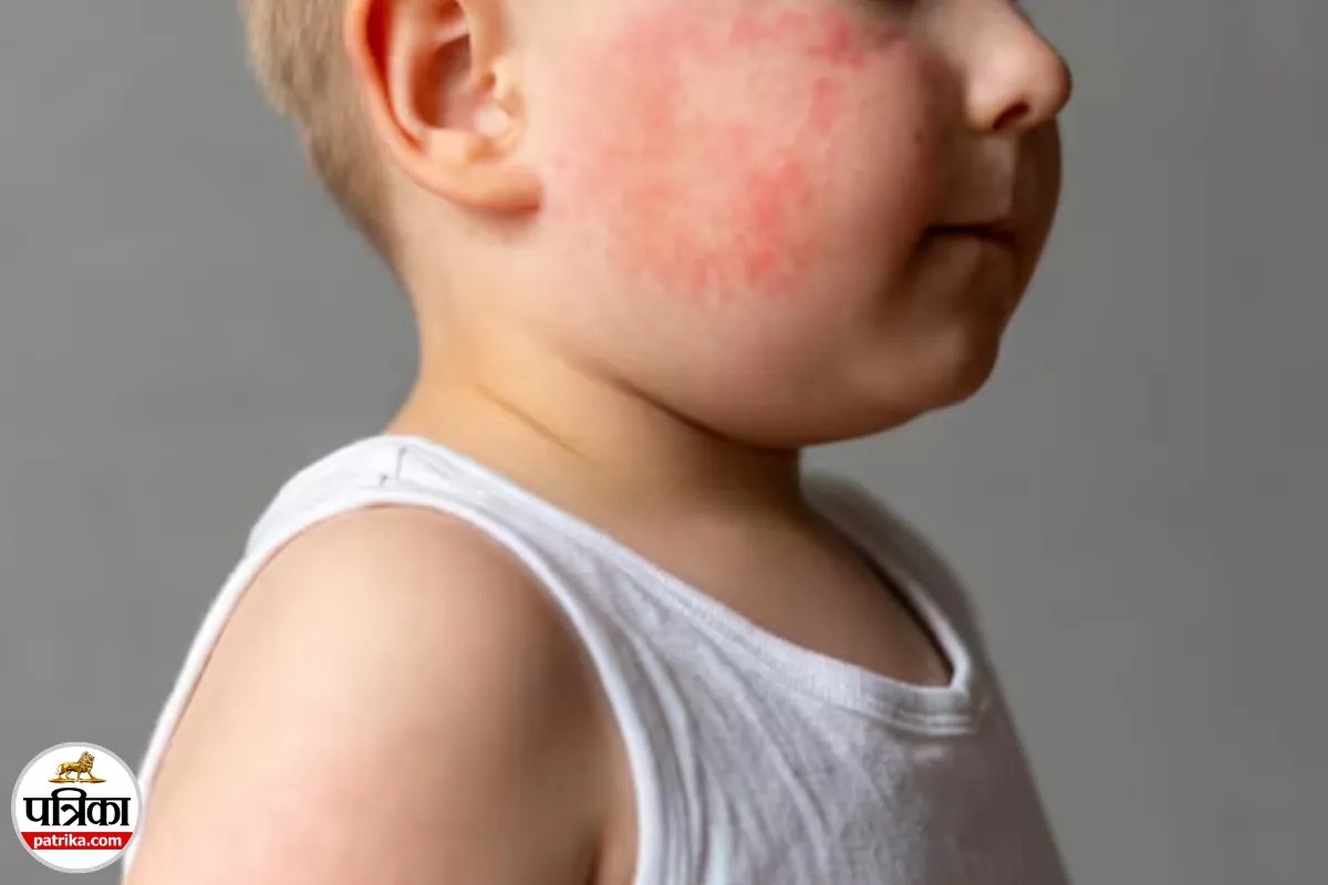 Impetigo Treatment, Impetigo In Children