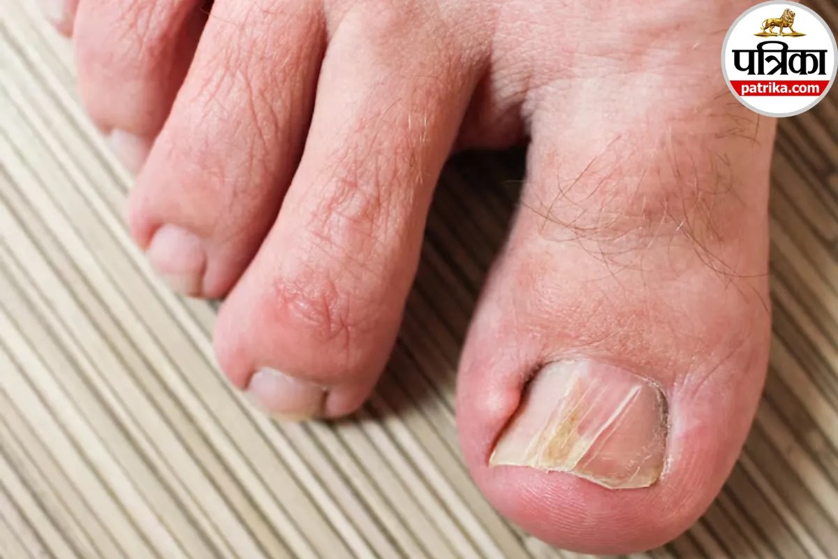 ingrown toenail causes and symptoms ,pain in big toe nail embedding skin,how to treat ingrown toenail at home ,