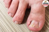 ingrown toenail causes and symptoms ,pain in big toe nail embedding skin,how to treat ingrown toenail at home ,