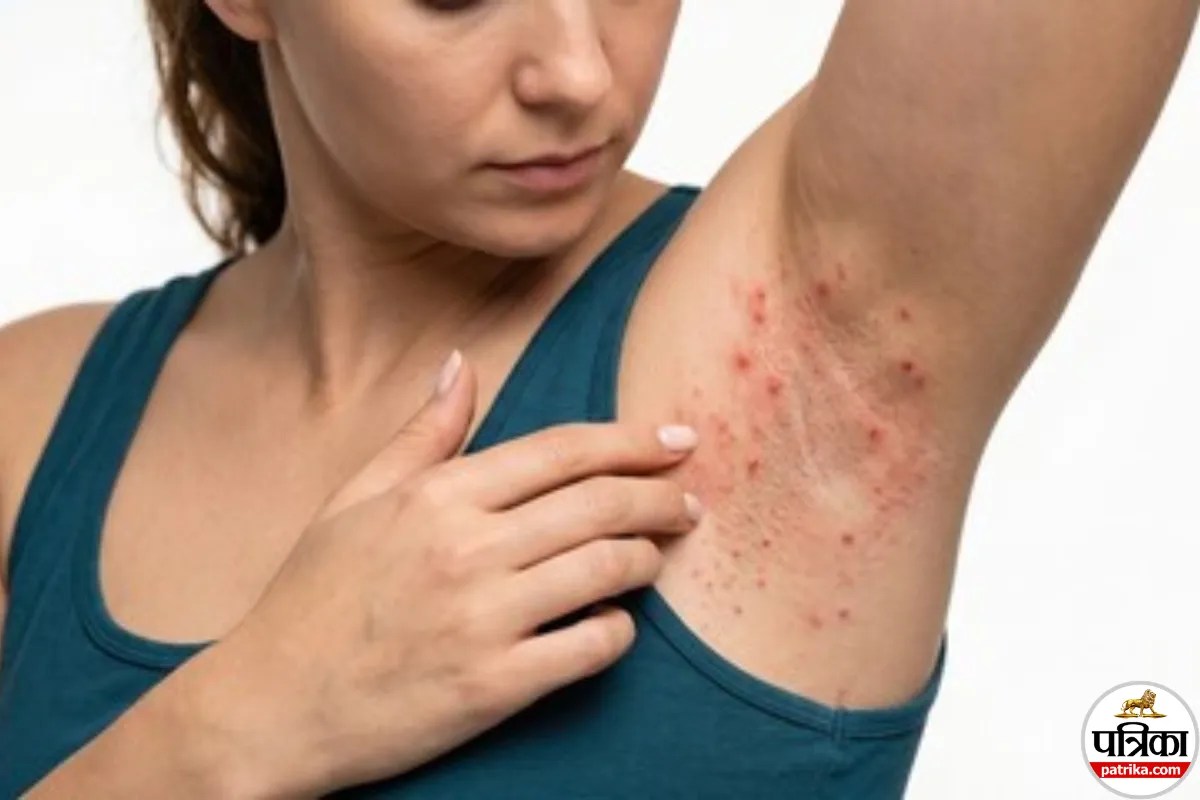 Intertrigo Treatment, Intertrigo Prevention