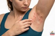 Intertrigo Treatment, Intertrigo Prevention