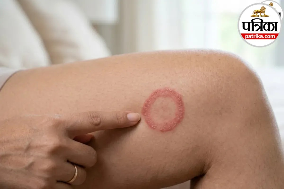 Jock itch symptoms,Tinea cruris causes,Thigh fungal infection treatment,