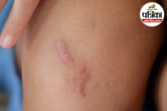 Keloid Scar Symptoms.Causes of Keloid Scars,Raised Scar Treatment,