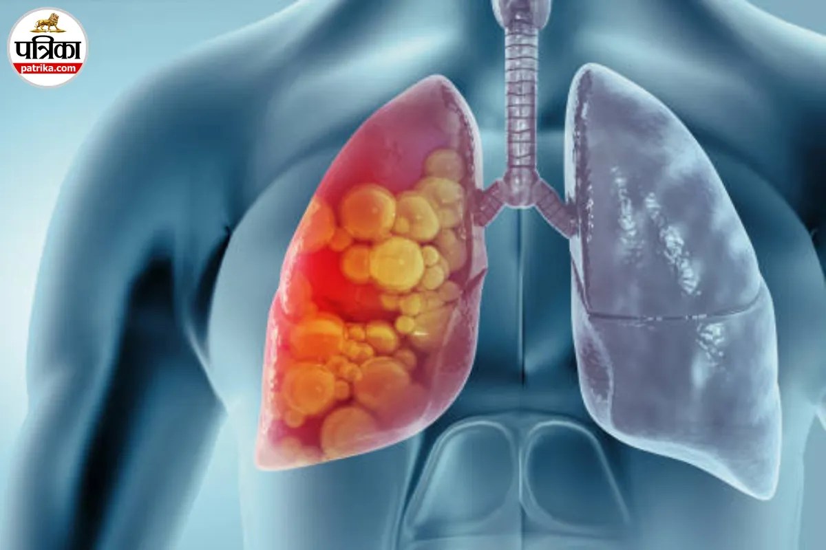 Lung Cancer After Quitting Smoking, Lung Cancer Causes