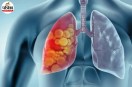 Lung Cancer After Quitting Smoking, Lung Cancer Causes
