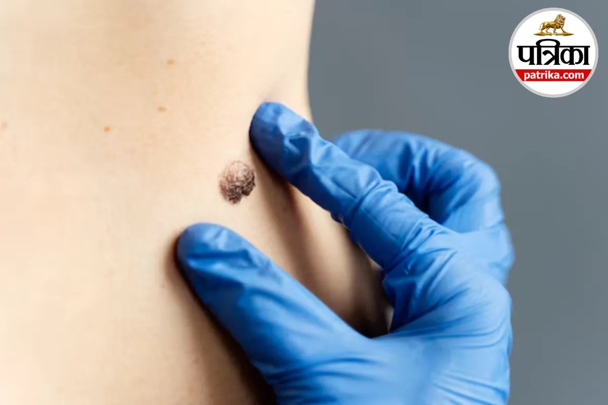 Changing mole symptoms, Skin mole melanoma signs, ABCDE mole rule, When to check moles, New mole on skin causes,