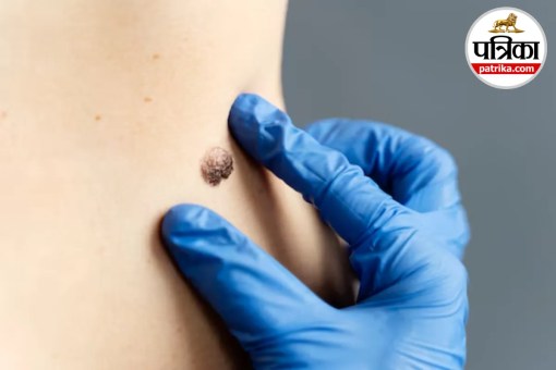 Changing mole symptoms, Skin mole melanoma signs, ABCDE mole rule, When to check moles, New mole on skin causes,